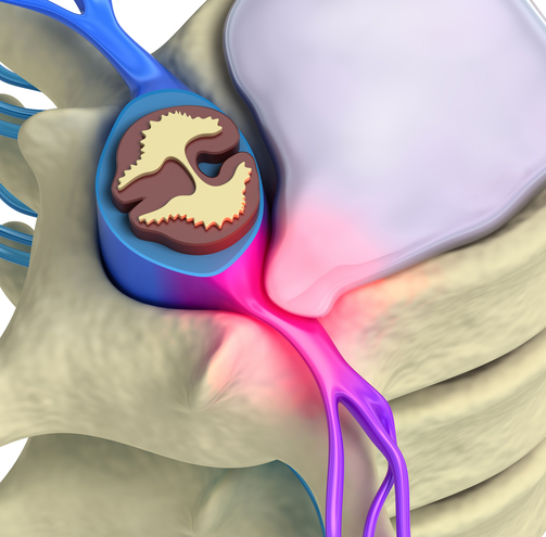 Tipos de lesión de la médula espinal