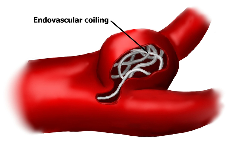 Endovascular Coiling Vs Clipping