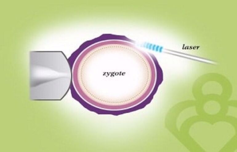 Laser Assisted Hatching Laser Aha