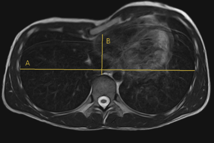 Funnel chest deformity