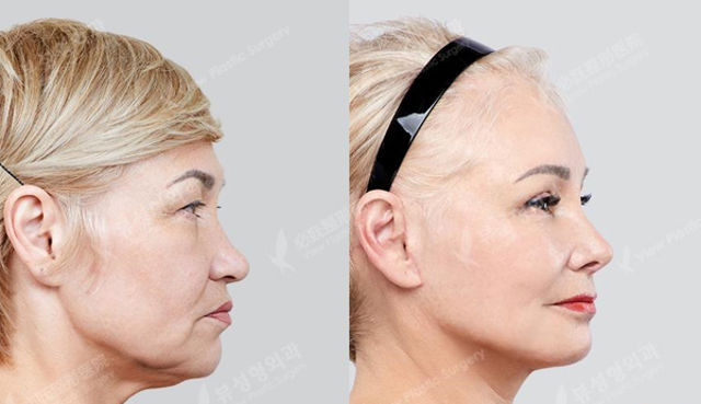 Trước và sau khi phẫu thuật 