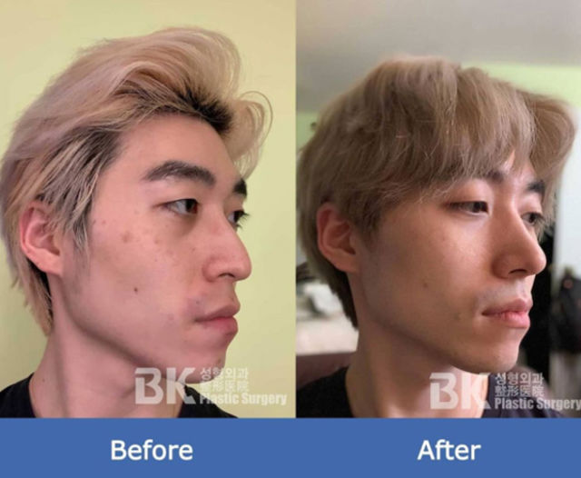 До и после операции на орлином носу