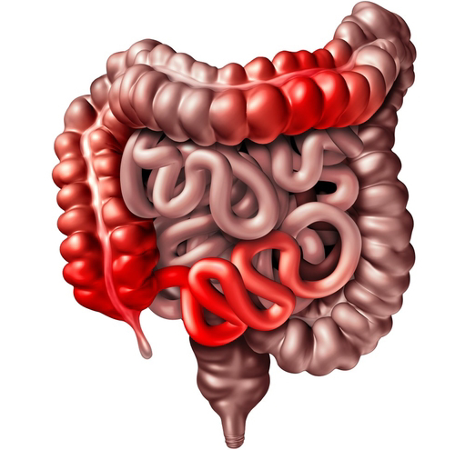 Abdominal Adhesions: What are They, Symptoms, Treatment