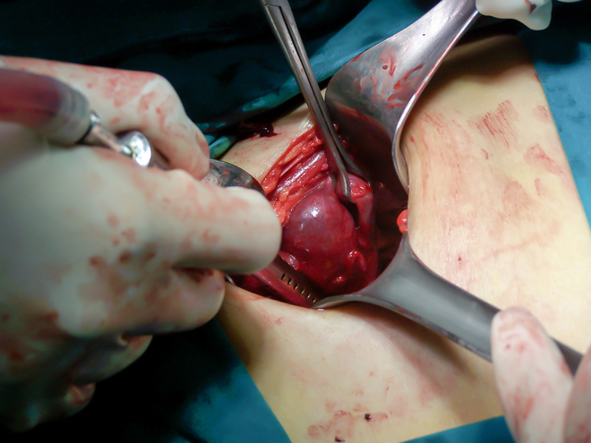 Bilateral Salpingectomy Procedure