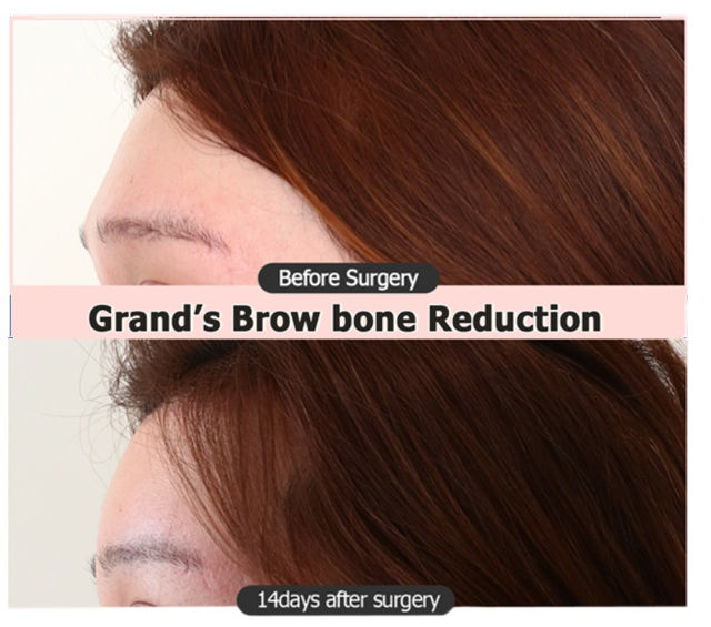 Brow Bone Reduction and Recovery