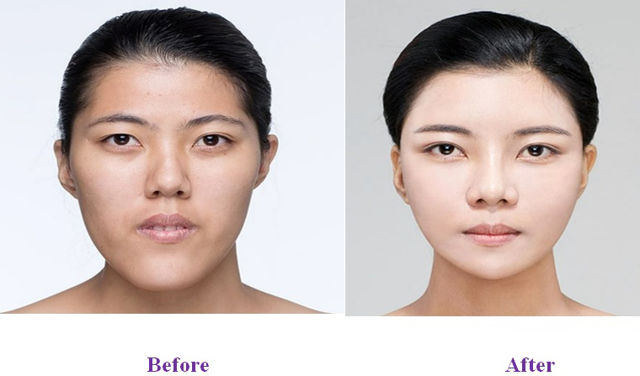 Benefits of Square Jaw Reduction Surgery
