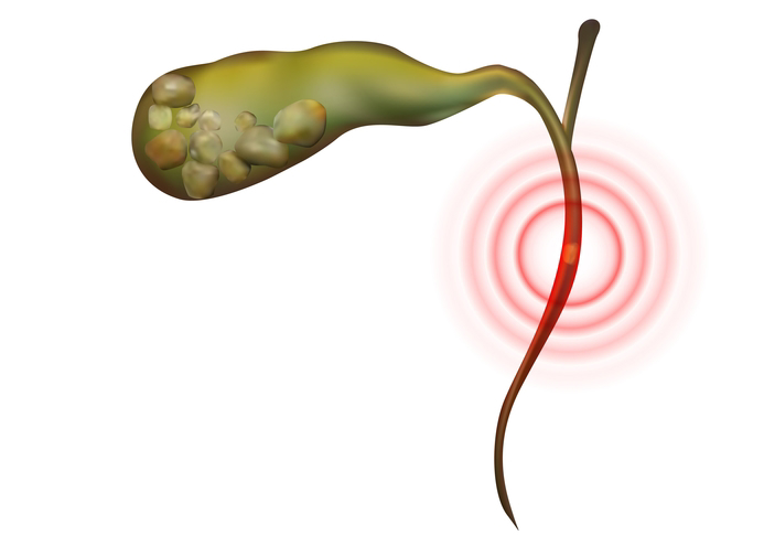 Endoscopic Choledochoduodenostomy