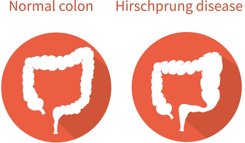 Bệnh Hirschsprung