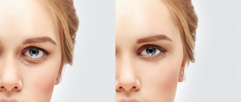 Efficacy of bling eye surgery