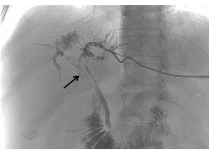 Percutaneous Transhepatic Cholangiography