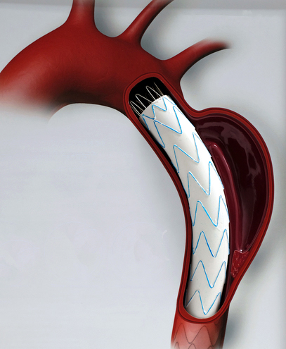 Thoracic aortic aneurysm