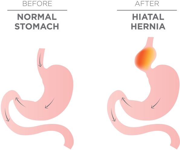 Stomach Hernia diagnosed