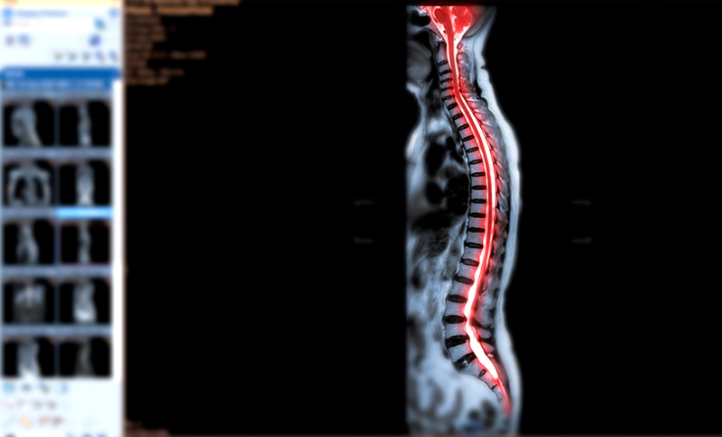 Low Back Discogenic Pain