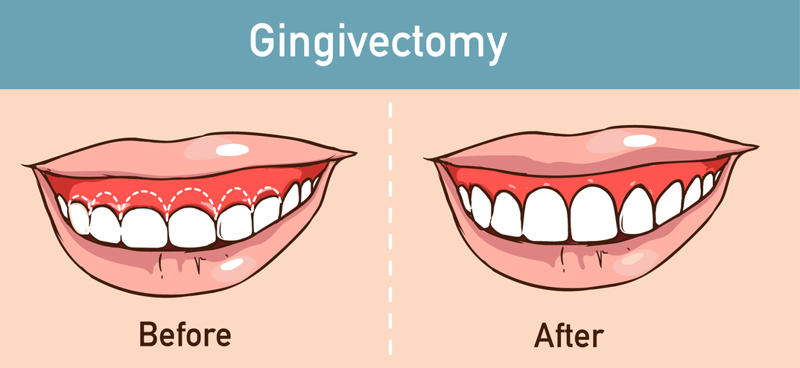 gingivectomy after care