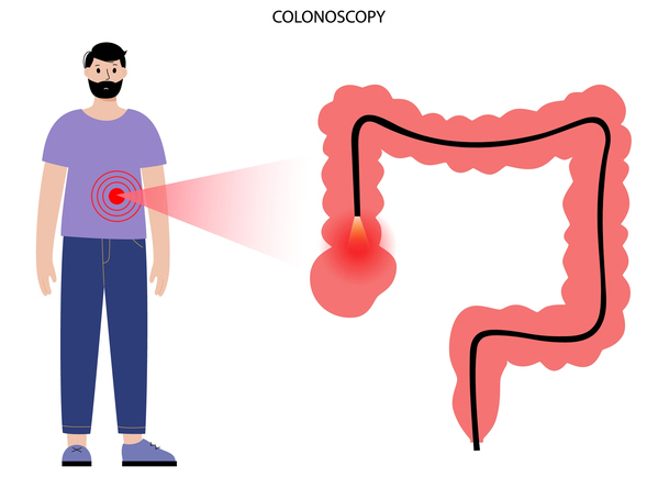 Diagnóstico de pólipos colorrectales