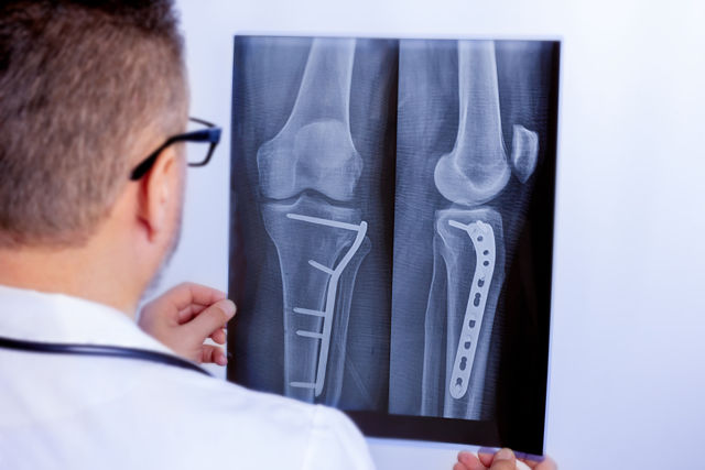 Complicaciones de la fractura ósea