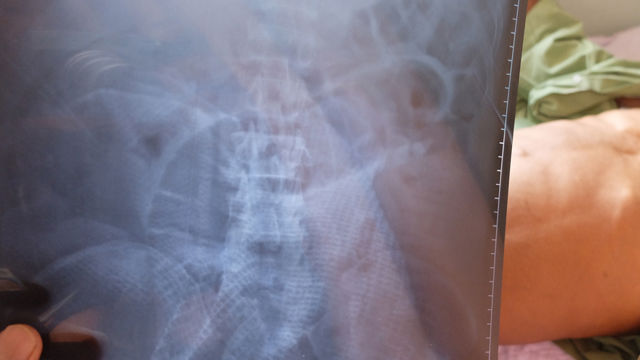 Barium X-ray