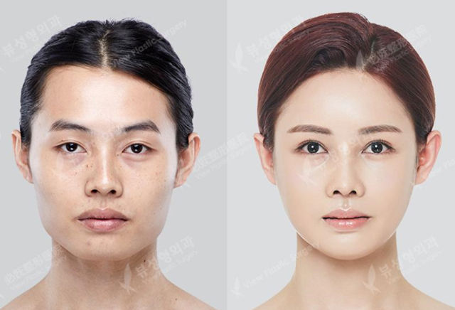 face contouring surgery