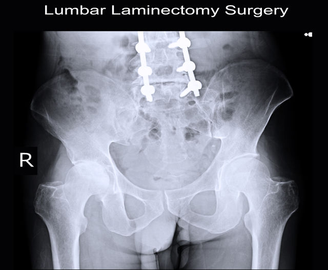 Anterior Lumbar Interbody Fusion (ALIF)