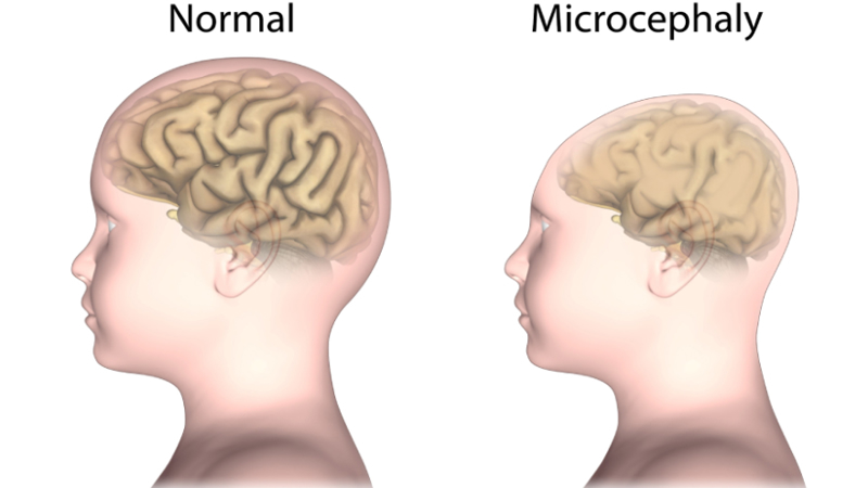 Anencephaly Causes Symptoms Diagnosis And Management   7 A11054f0 0f44 473a 97b3 282d15dfc91d 