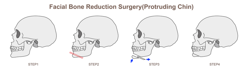 protruding-chin