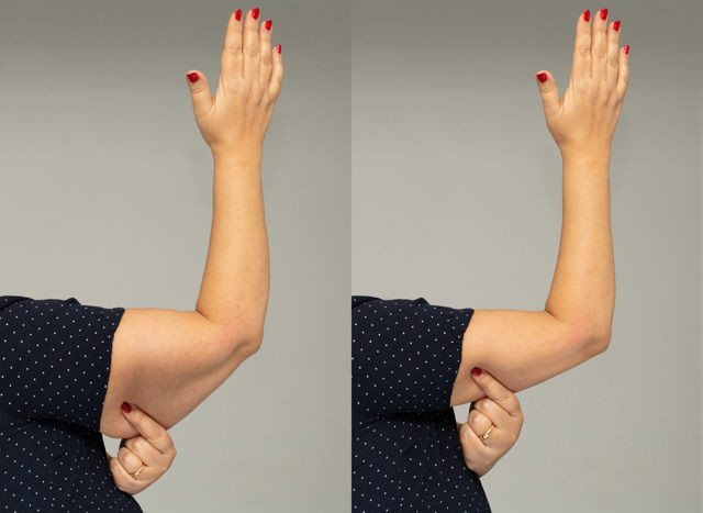 Rủi ro khi hút mỡ cánh tay