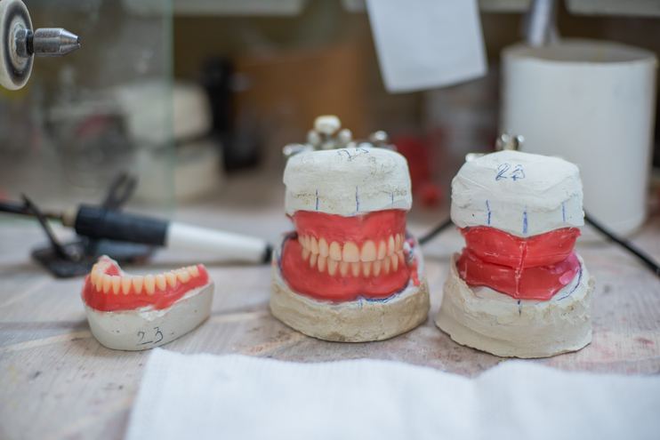 Răng giả đúc một phần so với so sánh răng giả acrylic thông thường