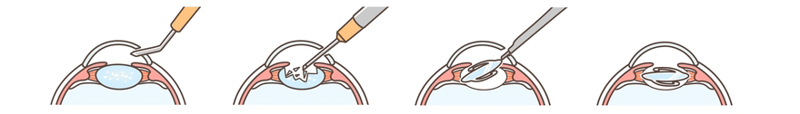 Cataract Surgery