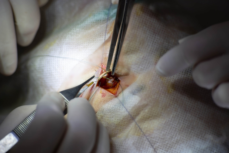 Surgical Treatment of Traumatic Nerve Injury