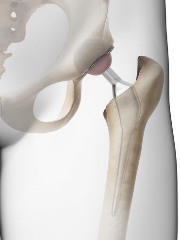 Total hip replacement surgery preparation