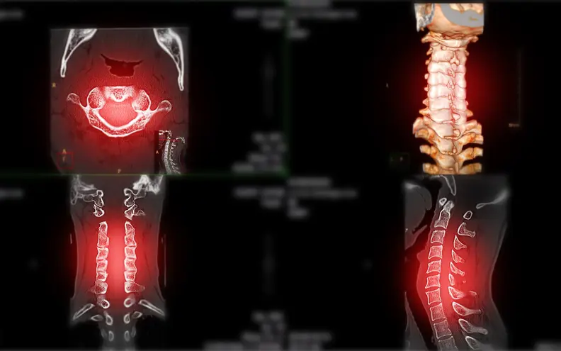 Spine trauma Imaging 