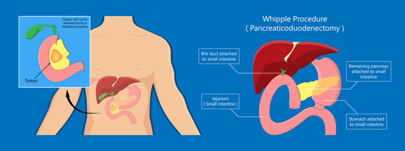 resección pancreática