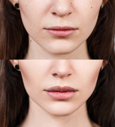 กระบวนการรักษาด้วยเทคนิค PRP Facial