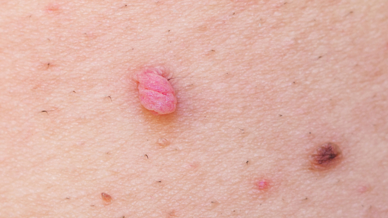 SKIN TAG - harmful or not?