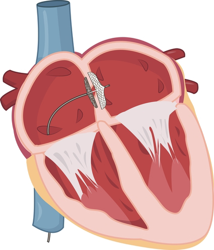 Atrial septal defect (ASD)