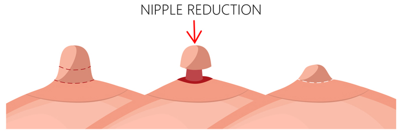 nipple and areola