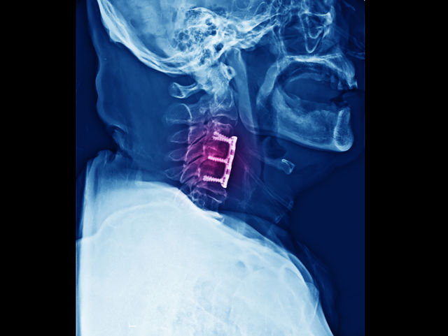 Các loại phẫu thuật phổ biến cho đau cổ