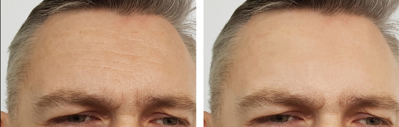 Forehead lift before and after