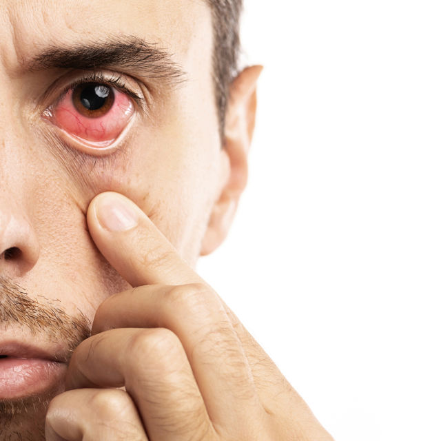 Síndrome do olho seco não tratada