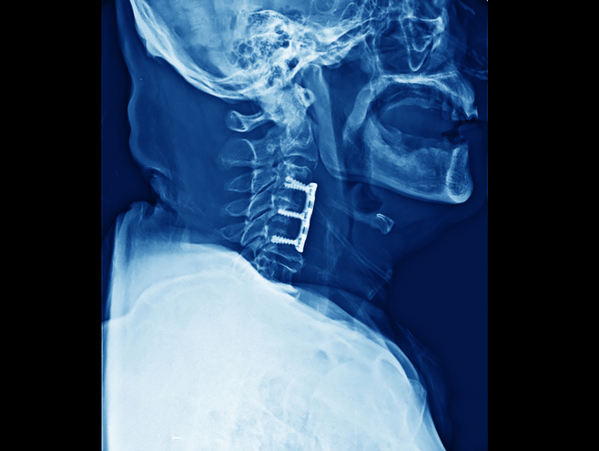 Cervical Disc Replacement vs ACDF