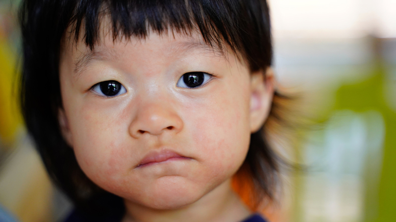 children with Pityriasis Versicolor