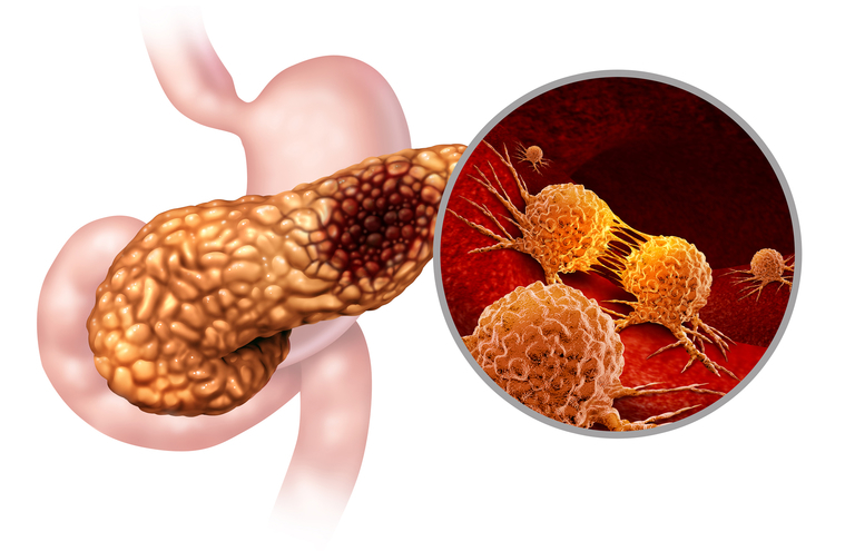 resección pancreática en cáncer de páncreas
