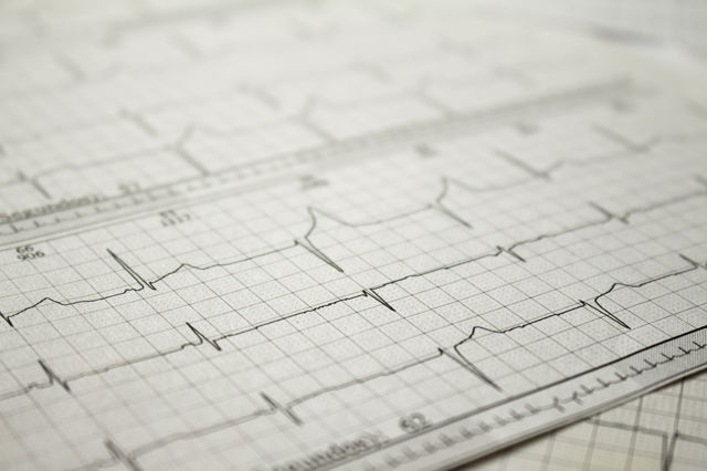 Cardiac Arrhythmia by Holter Monitor