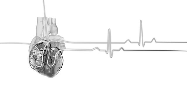 ECG de infarto agudo de miocardio