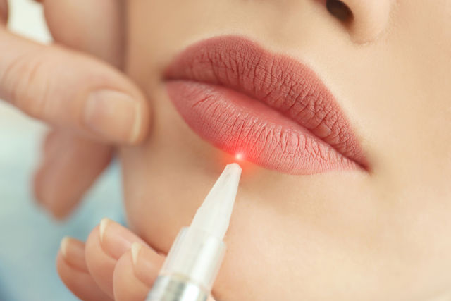 Что такое лазерная шлифовка губ