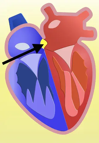 ASD (Atrial Septal Defect) Repair