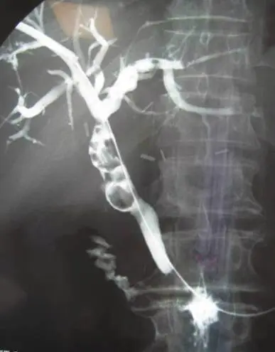 PT Cholangiography (Liver and Bile Duct Imaging)