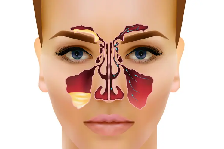 Sinus maxillaris стенки