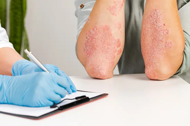Eczema (Dermatitis)