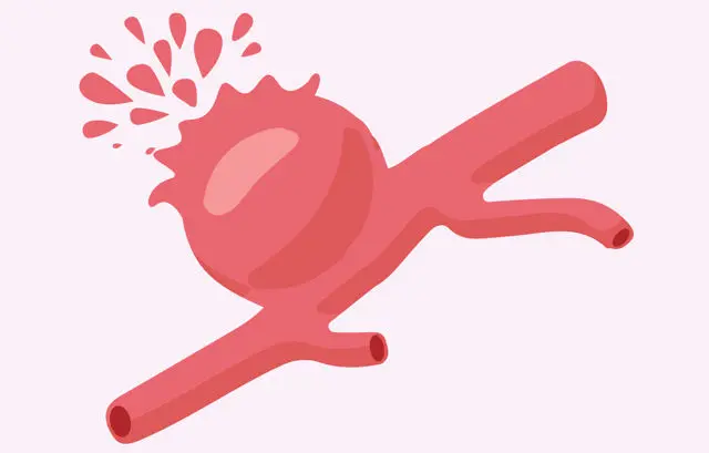 Aneurysm: A Complete Guide to Causes, Symptoms, and Treatment Options